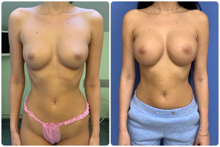 Красивая грудь с имплантами