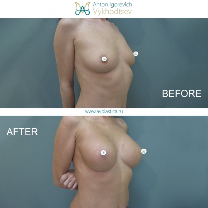 Грудь после увеличения имплантами
