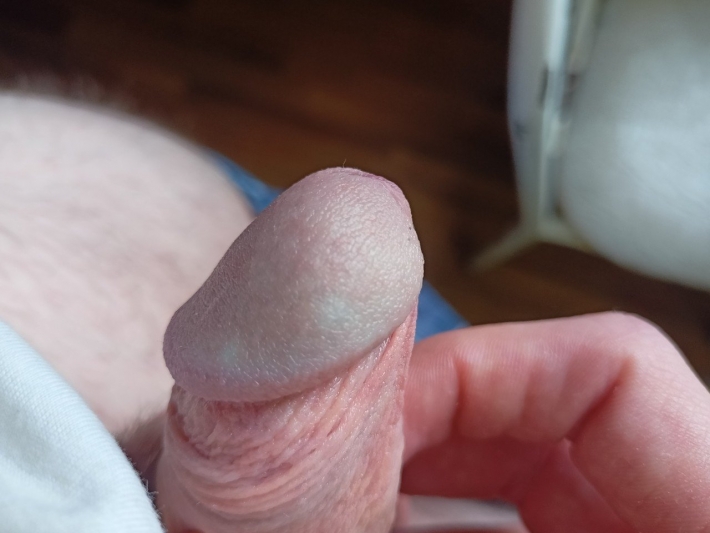 Закрытая головка члена