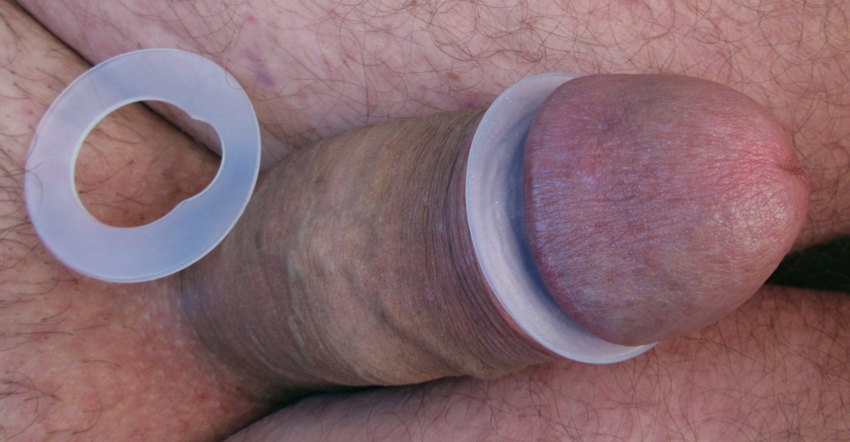 Склероатрофический баланит